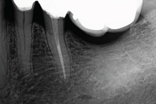 Fig 4: Post-op showing perfect adaptation to canal shape