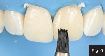 ResinBlend is used to smooth the composite into surrounding tooth