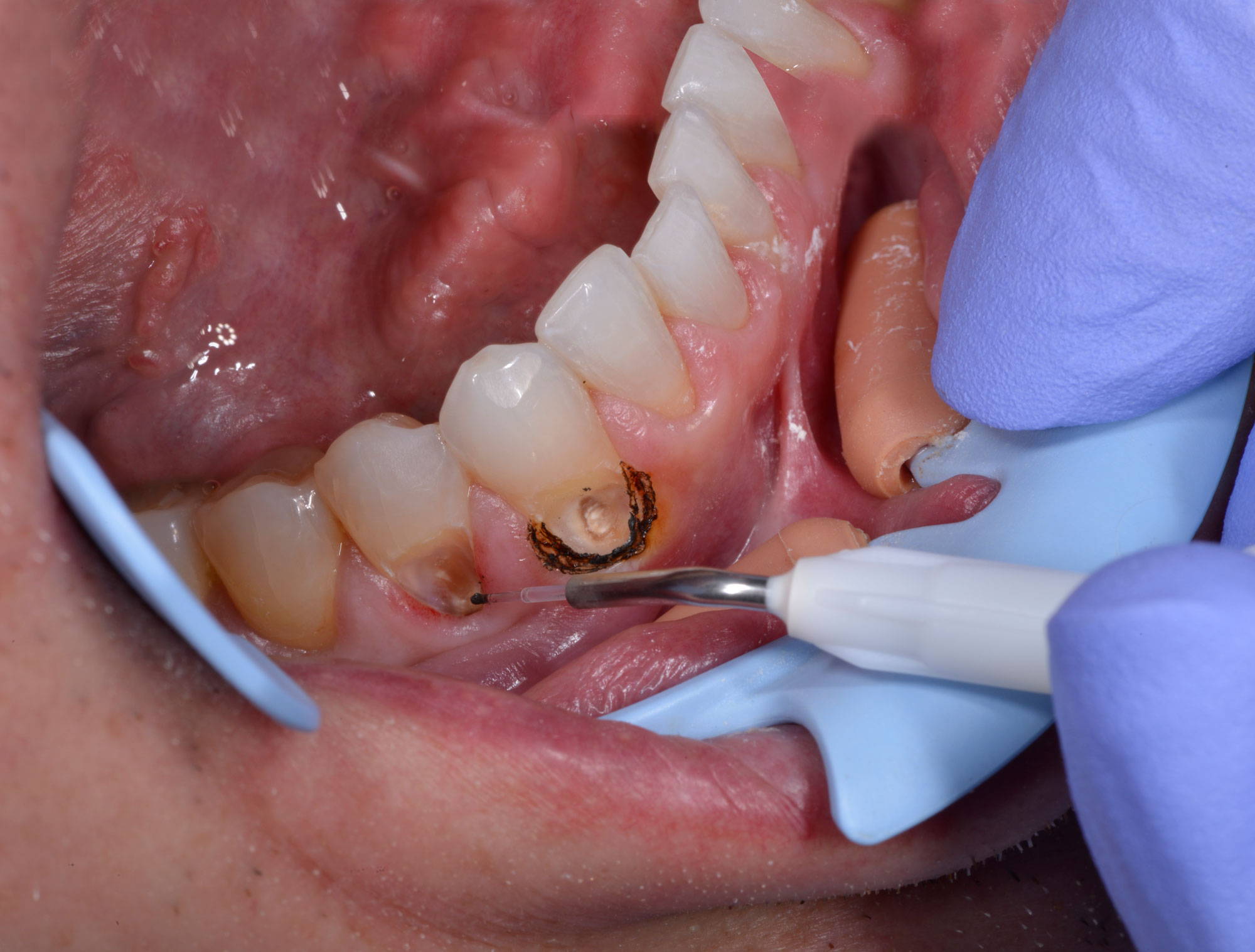 Laser tip touching teeth in subgingival decay