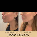 Jaw Fillers Wilmslow Before & After Dr Sknn
