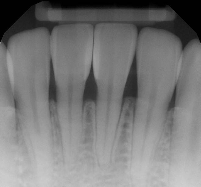 Port operative xray