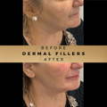 Jaw Fillers Wilmslow Before & After Dr Sknn