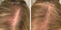 Nulastin-Scalp-Hair-Results-Before-After