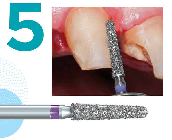 856XC Komet diamond bur and its clinical application (crown preparation of a tooth)