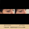 Tear Trough Fillers Wilmslow