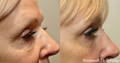 Side view of woman's sagging under eye area before and after Morpheus8