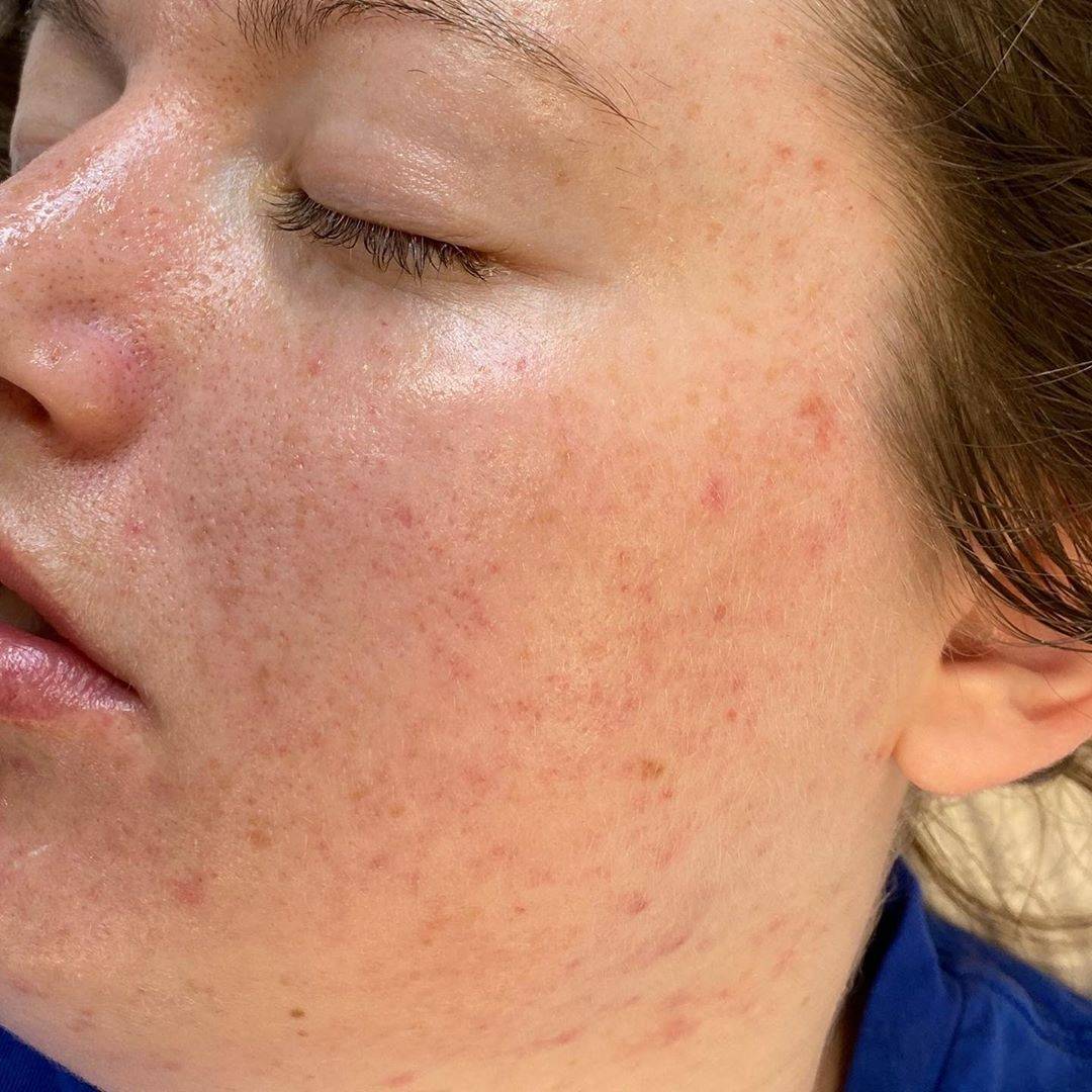Dr Sknn Dermalux Tri-Wave MD Acne After
