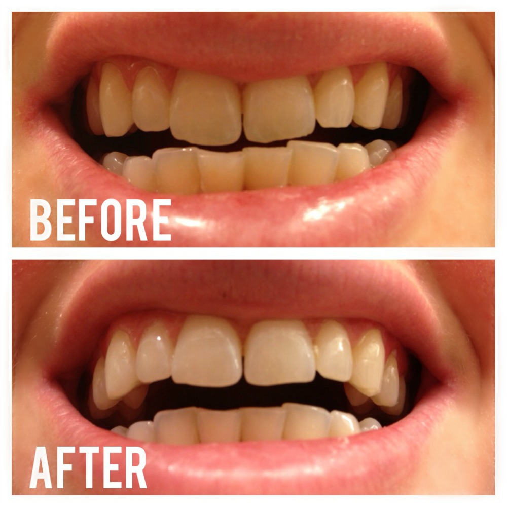 Activated charcoal teeth whitening how often