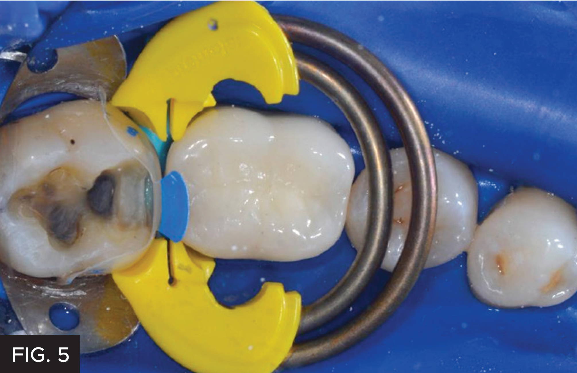 Class II Restoration: Bioclear. Fig. 5