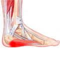 anatomical body highlighting the foot where you get plantar fasciitis