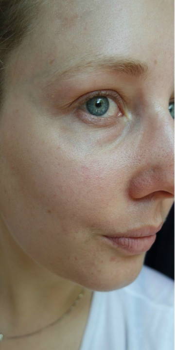 WunderHaut Anti-Aging Genius™ mit Radiofrequenz, LED Licht- und Mesotherapie, EMS und Elektroporation