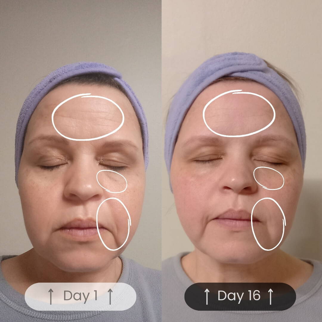 The RayJuvenate Wand before and after picture results one