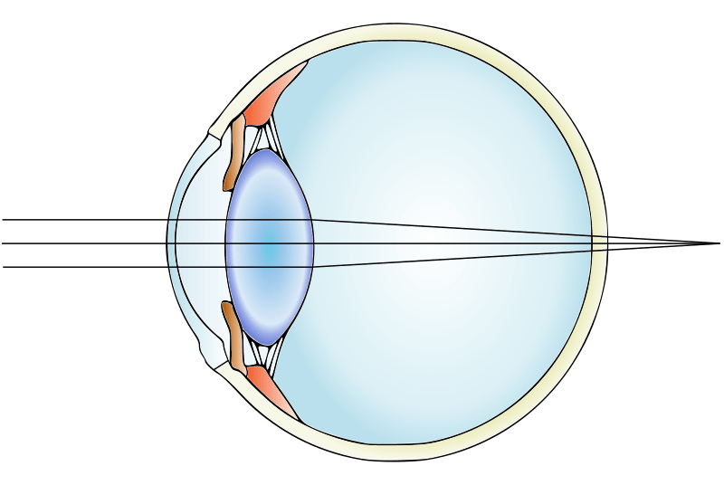 Farsighted or hyperopic eye