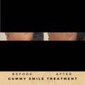 Gummy Smile Correction Fillers Before & After