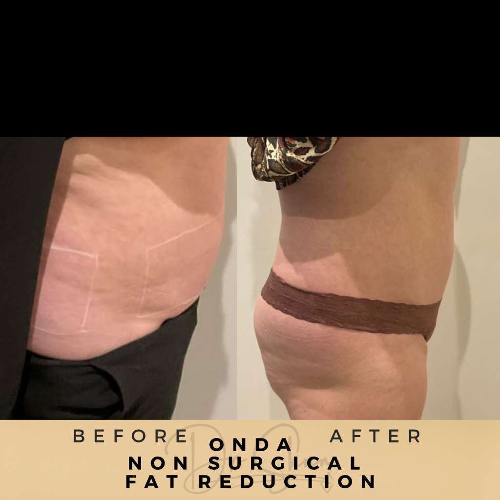 Non Surgical Fat Reduction Wilmslow Before & After Dr Sknn ONDA