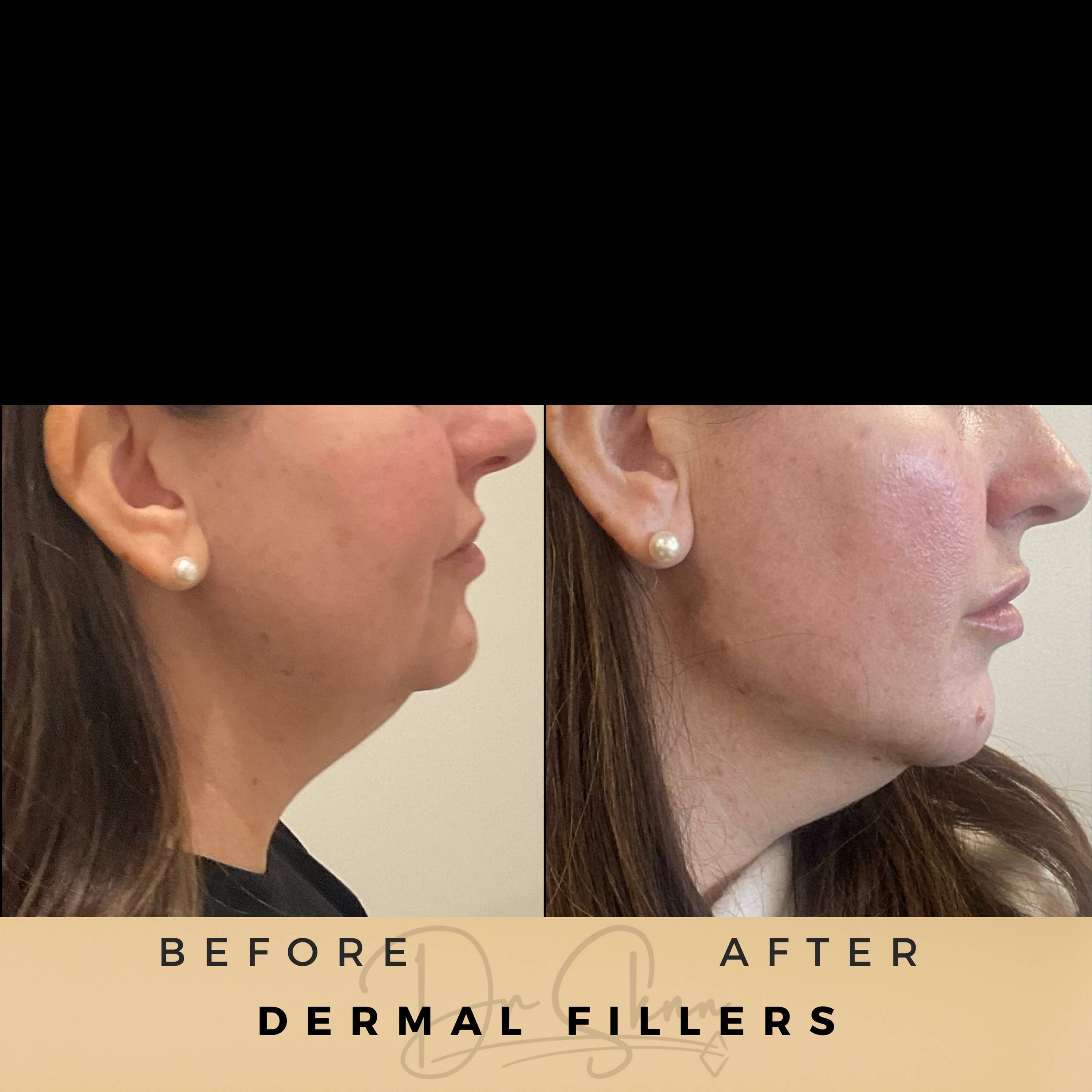 Jawline Fillers Wilmslow Before & After Dr Sknn