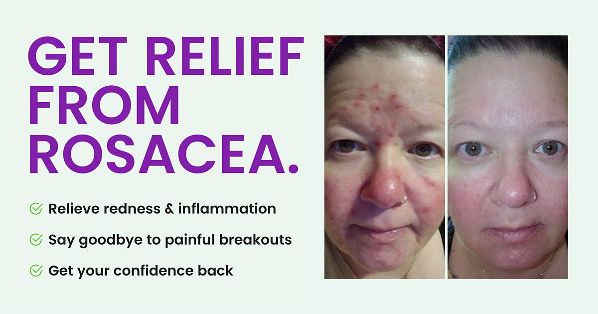 Aloe Skin Care for Rosacea Relief