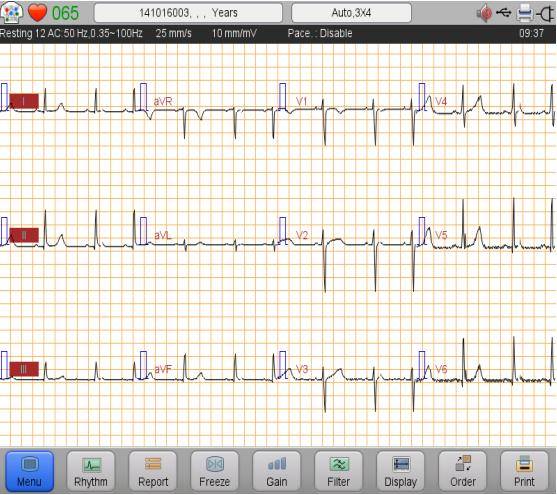 Das Biocare iE6 EKG-Gerät unterstützt die gleichzeitige Erfassung von 12 Ableitungen