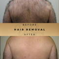 Laser Hair Removal Wilmslow Dr Sknn Before & After Picture
