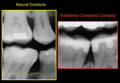The Seven Deadly Sins of Traditional Class II Restorations
