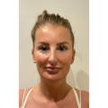ONDA - NON-SURGICAL FAT REDUCTION, CELLULITE REDUCTION & SKIN TIGHTENING - before picture Submental / Neck Area