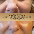Cheek Fillers Wilmslow