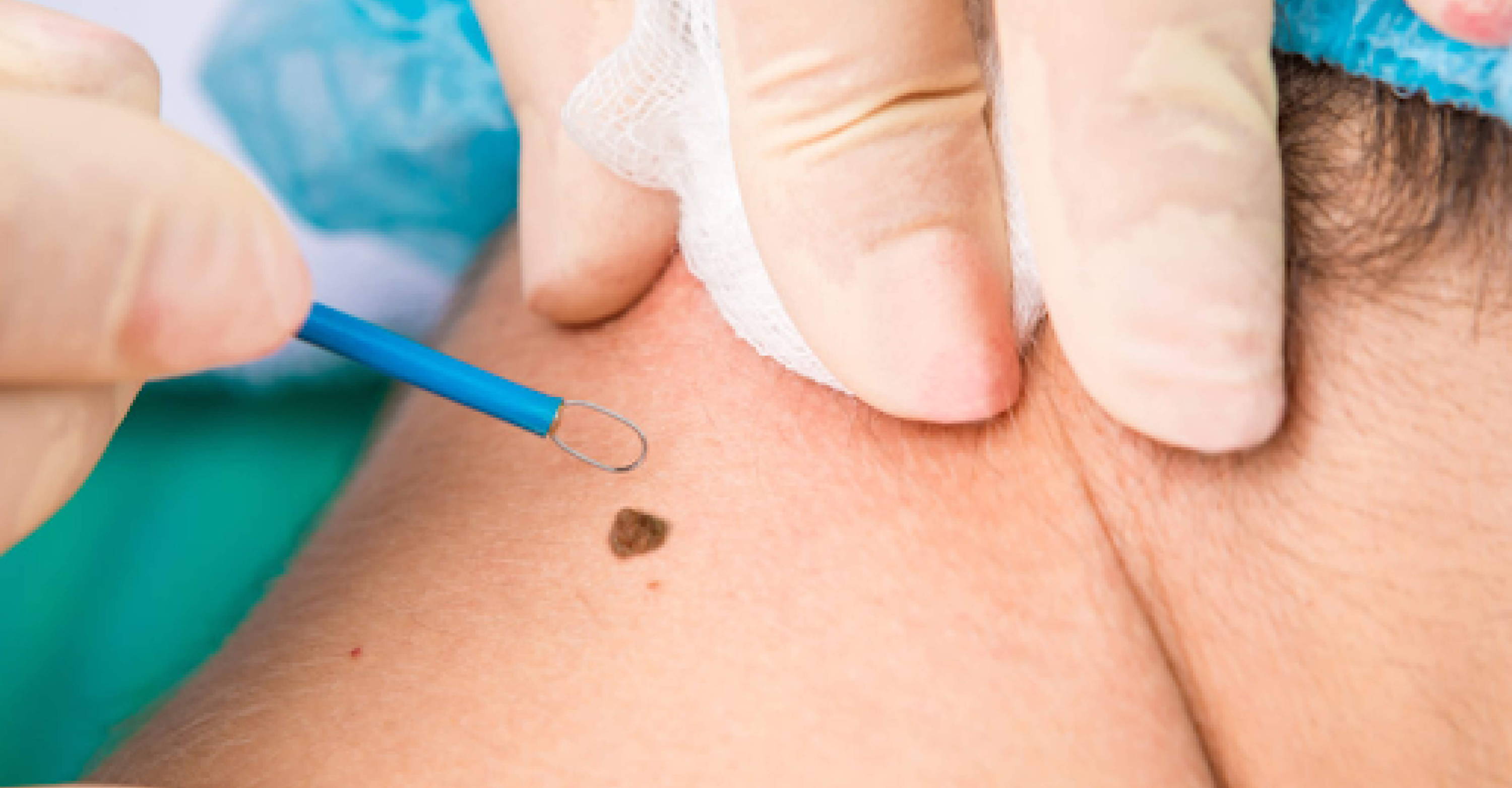 Cauterization and Electrocautery for skin tag removal