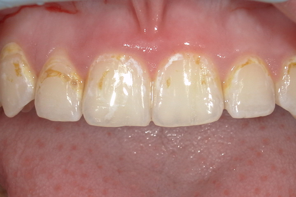 Stained teeth before treatment
