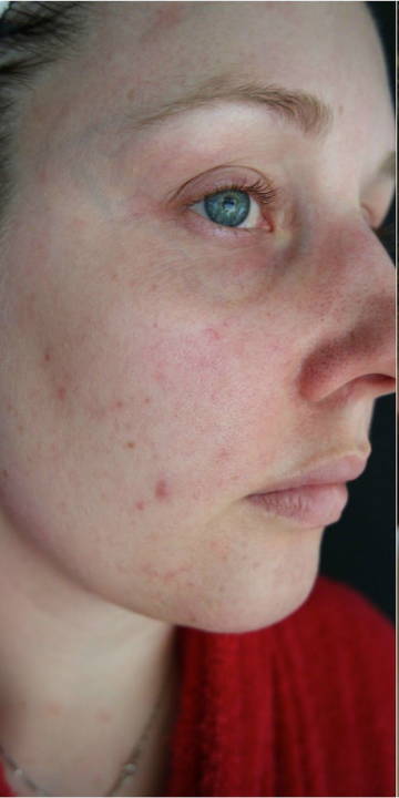 WunderHaut Anti-Aging Genius™ mit Radiofrequenz, LED Licht- und Mesotherapie, EMS und Elektroporation
