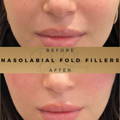 Nasolabial Fold Fillers Wilmslow