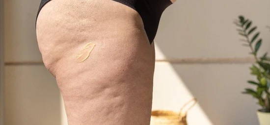 Mujer celulitis