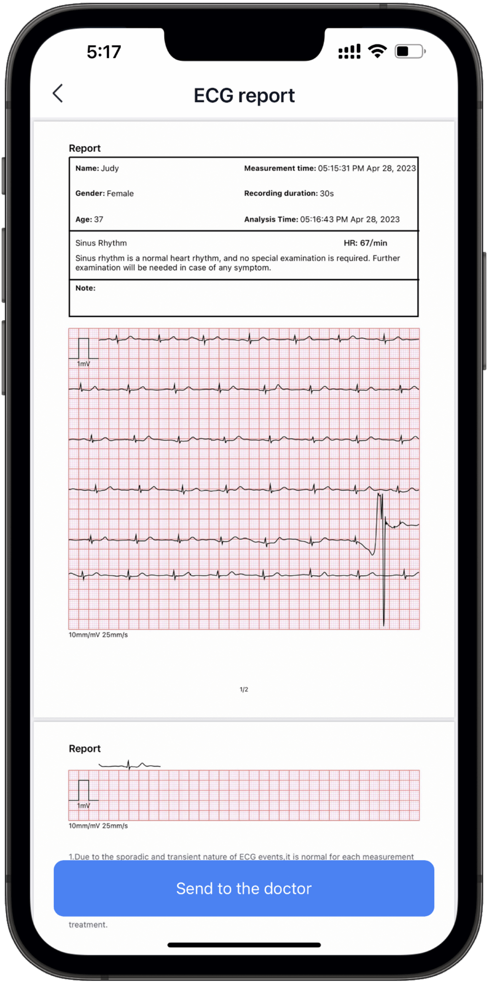 screen for arrhythmias with wellue AI analysis system