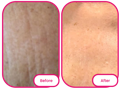 skin before and after taking the best collagen gummies singapore