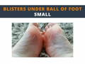 Blisters under ball of foot