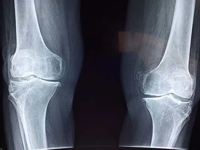 Anti-inflammatory Foods and Healthy Joints