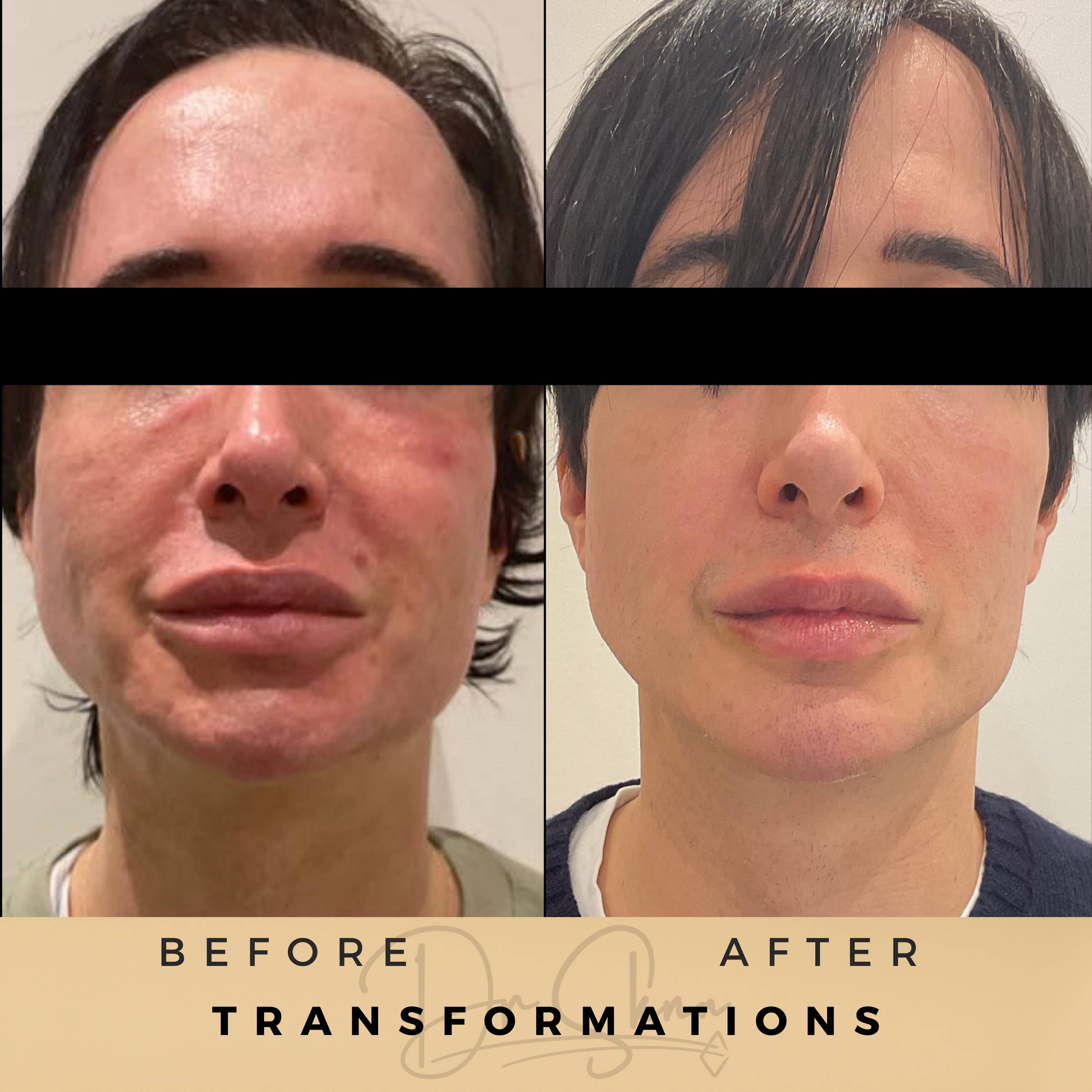 Transformations Aesthetic Clinic Wilmslow Before & After Dr Sknn