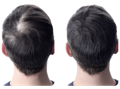 Before and after results of using our best vitamins for hair growth on a man's head