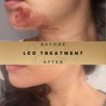 Before & After Pictures Dr Sknn Wilmslow Cheshire