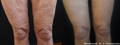Woman's wrinkled lower thighs and knees before and after Morpheus8