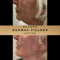 Jowl Fillers Wilmslow Dr Sknn Before & After Picture