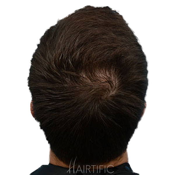 laser helmet for thinning crown, lllt helmet for crown, laser helmet for balding