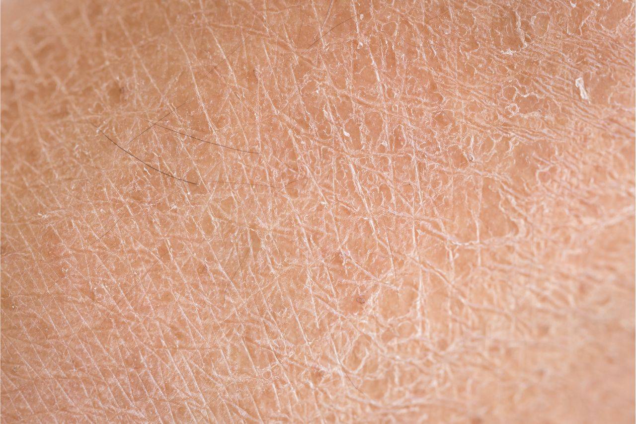 Hauttyp: Trockene Haut – Beitragsbild