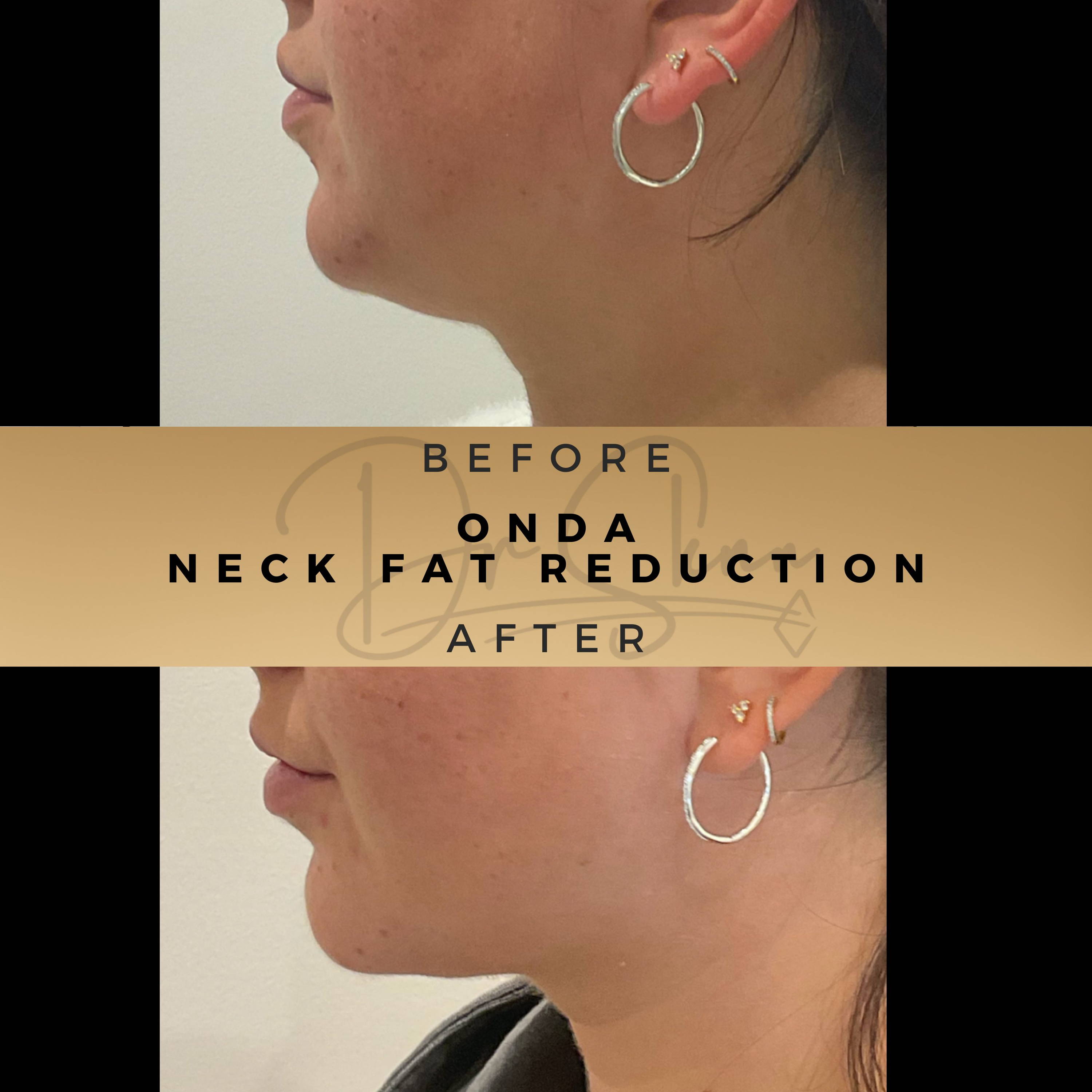 Neck Tightening Treatment Wilmslow Before & After Dr Sknn
