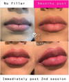 Woman's lips before and after JUVÉDERM Ultra Plus