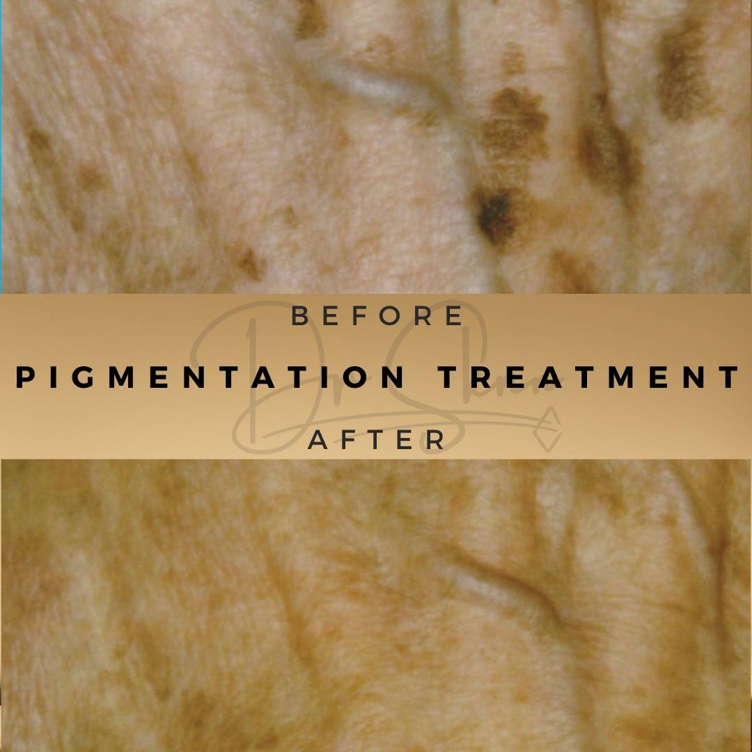 Pigmentation Treatment Wilmslow Before & After Dr Sknn