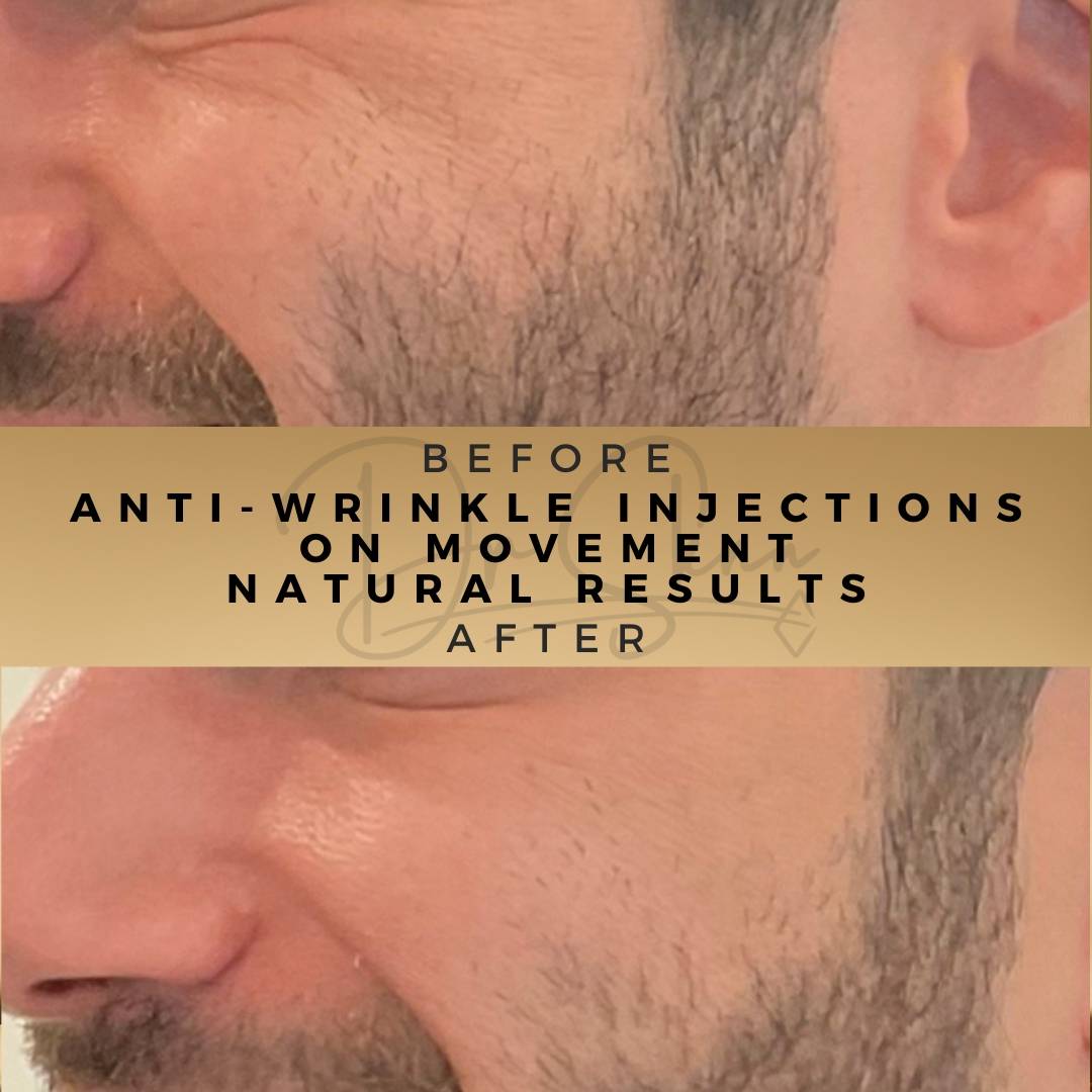 Anti-Wrinkle Injections Wilmslow Before & After Dr Sknn