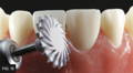 ASAP polishing tooth