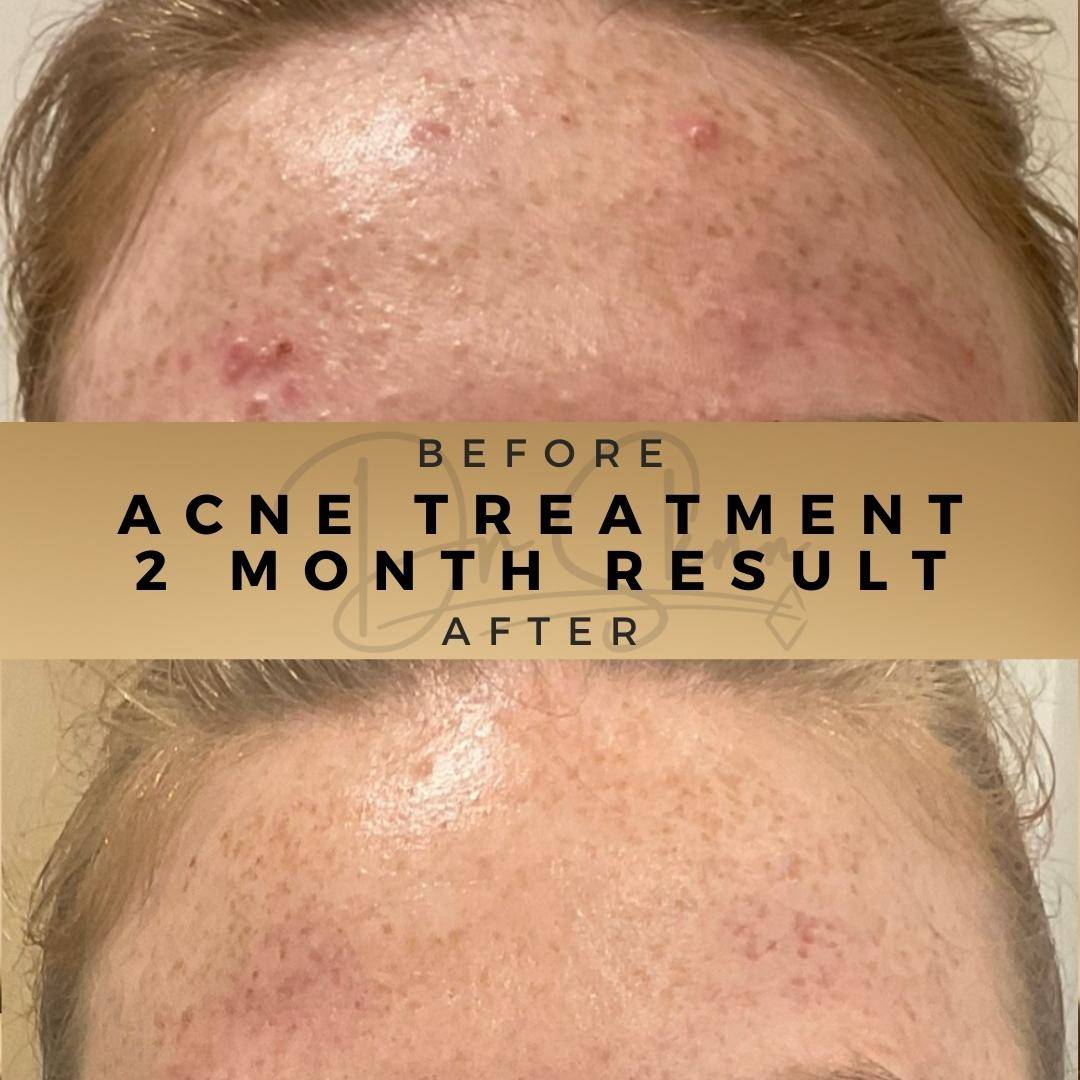 Acne Treatment Wilmslow Before & After Dr Sknn