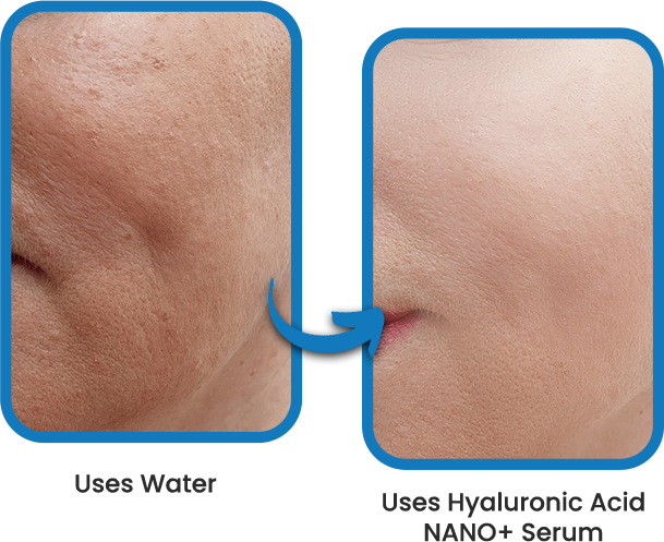 Comparison between an individual who uses only water and NANO SKIN Hyaluronic Acid Serum