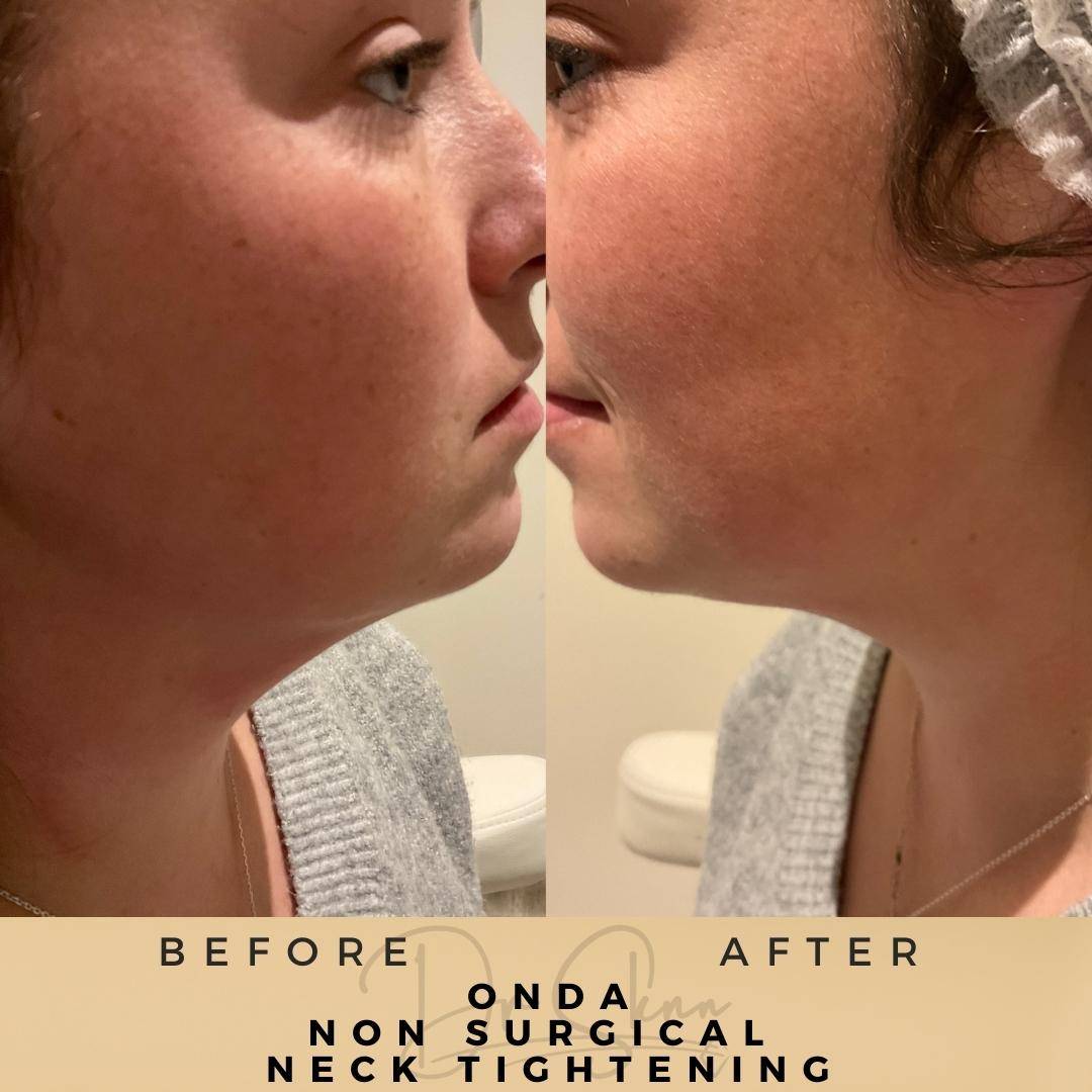 Neck Tightening Treatment - Dr Sknn before and after